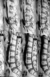 spinal xrays