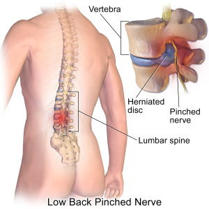 pinched nerve diagram back injury