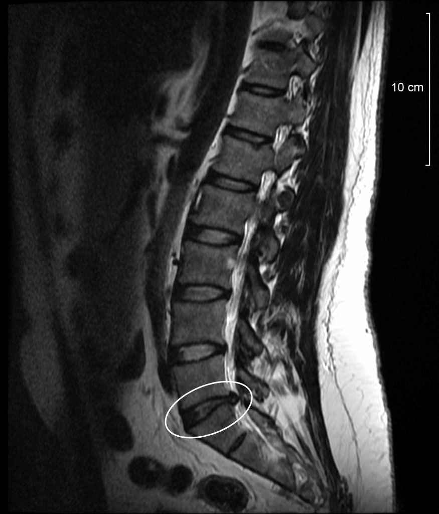 Suffering from a Herniated Disc After Car Accident?